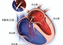 青海一患者心脏上有个&amp;quot;小洞&amp;quot;，仁济专家在浦南医院完成高质量手术