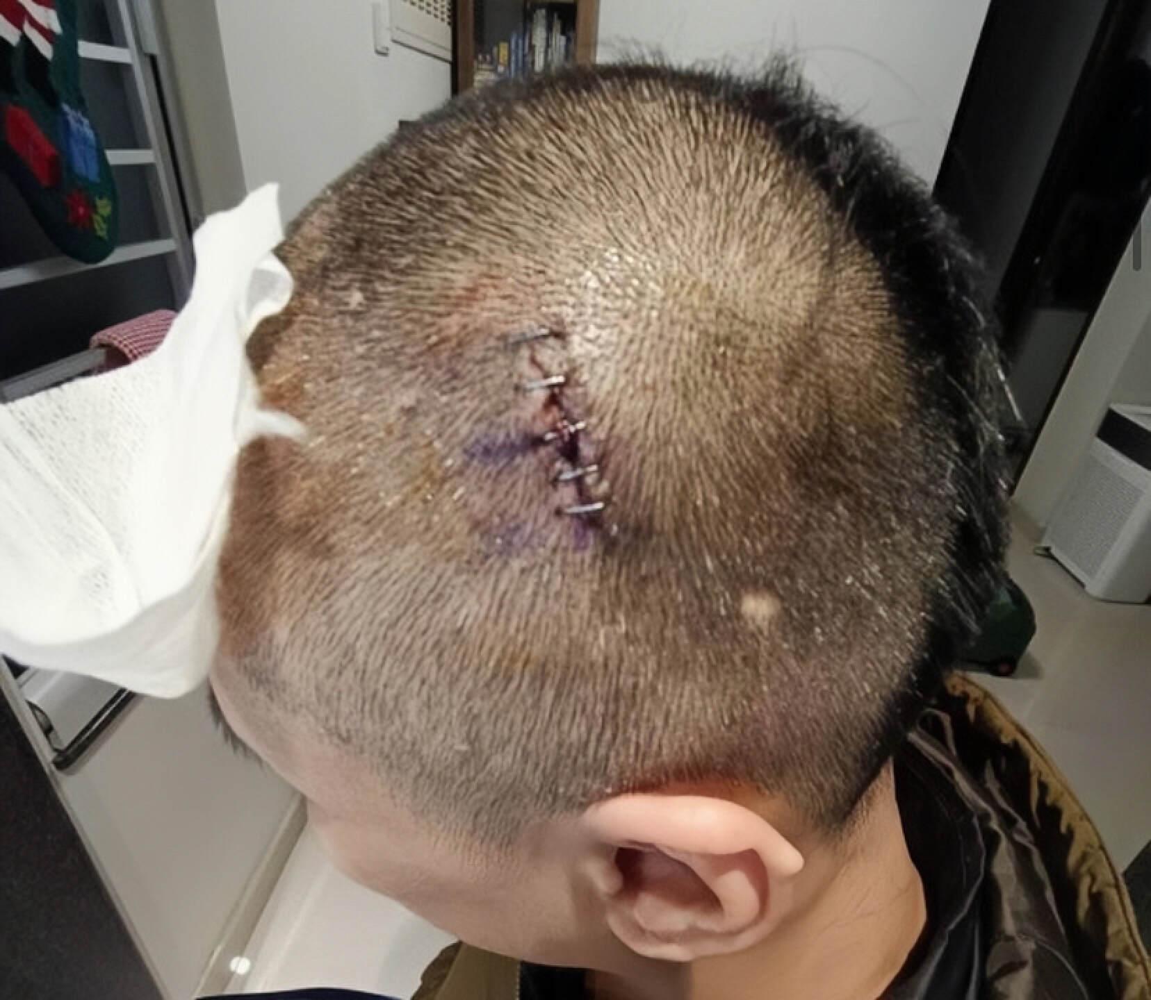 香港知名男星遭妻子家暴，头部受伤见血，网友直呼：都是报应